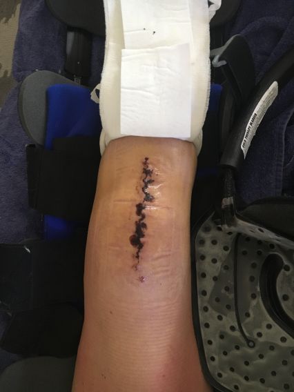 Knee Incision and brace