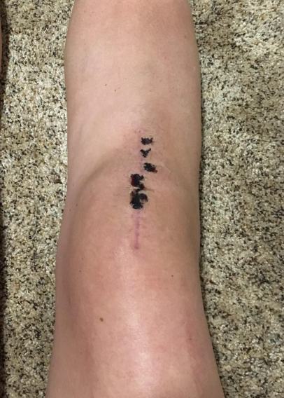 Knee Incision2